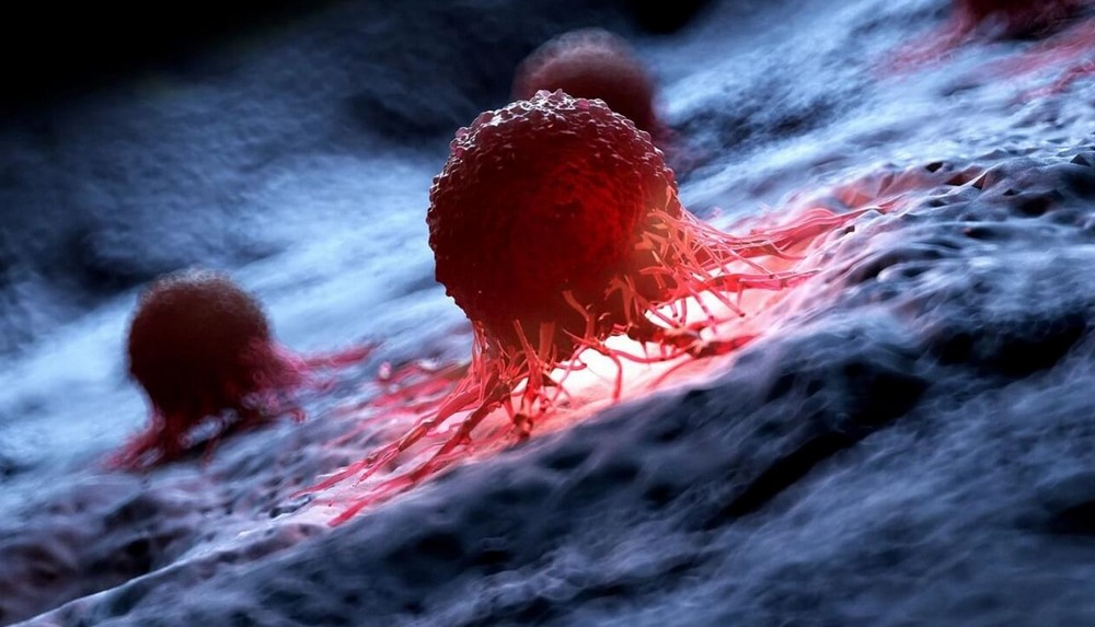 ბოლო 30 წელიწადში მსოფლიოში კიბოს შემთხვევები 80%-ით გაიზარდა – რას უკავშირებენ მკვლევრები ადრეული კიბოს ზრდას